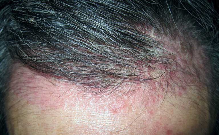 Top 3 loại dầu gội trị viêm da đầu được chuyên gia y khoa khuyên dùng