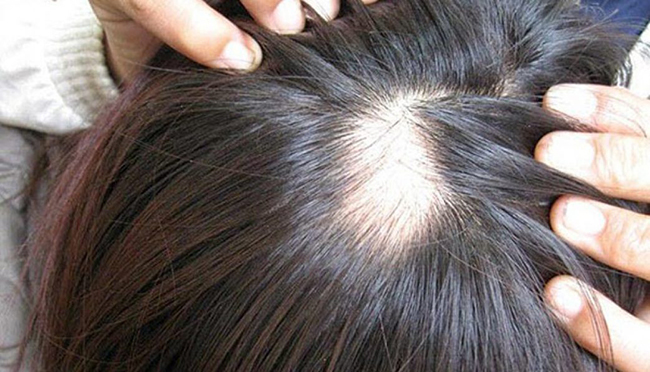 Tóc bị hói ở đỉnh đầu - 5 Cách giúp giảm rụng và kích thích mọc tóc 