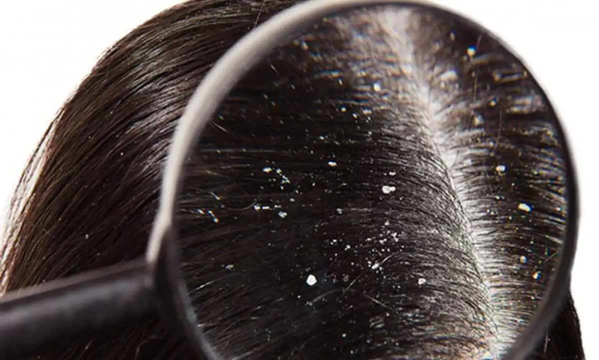 TOP 5 cách trị gàu ống trên tóc hiệu quả, đơn giản tại nhà